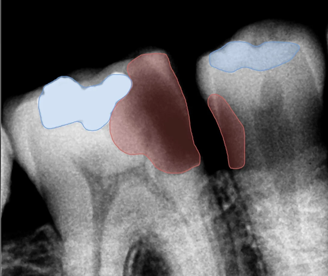 Periapical capturada con Orion Bridge y anotada por Orion+: dos caries delineadas en rojo y dos obturaciones en azul sobre la imagen.